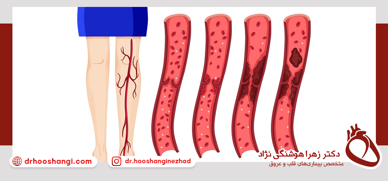 اولین اقدام برای درمان واریس چیست؟