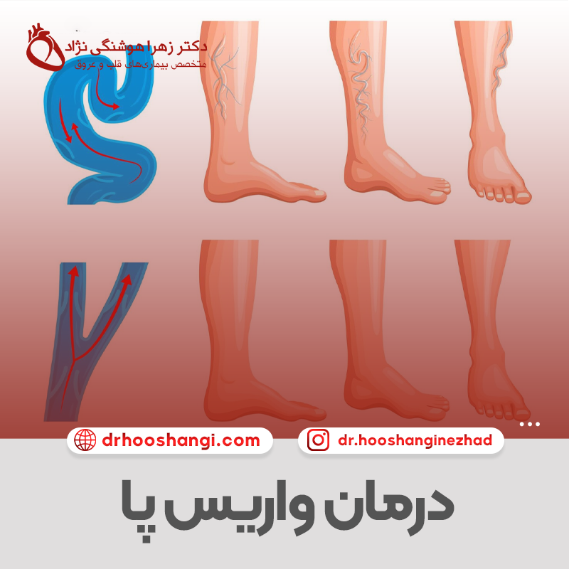 درمان واریس پا
