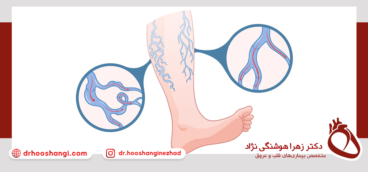 تاثیر ورزش بر درمان واریس