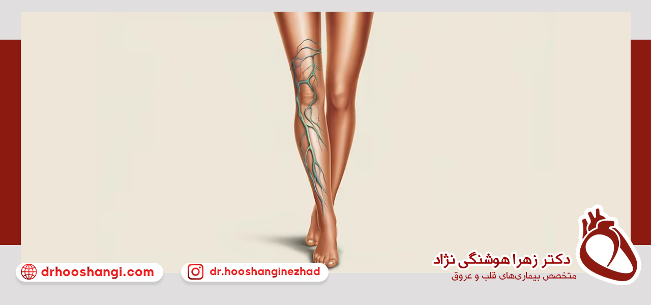 تصویربرداری با اشعه ایکس برای تشخیص واریس پا
