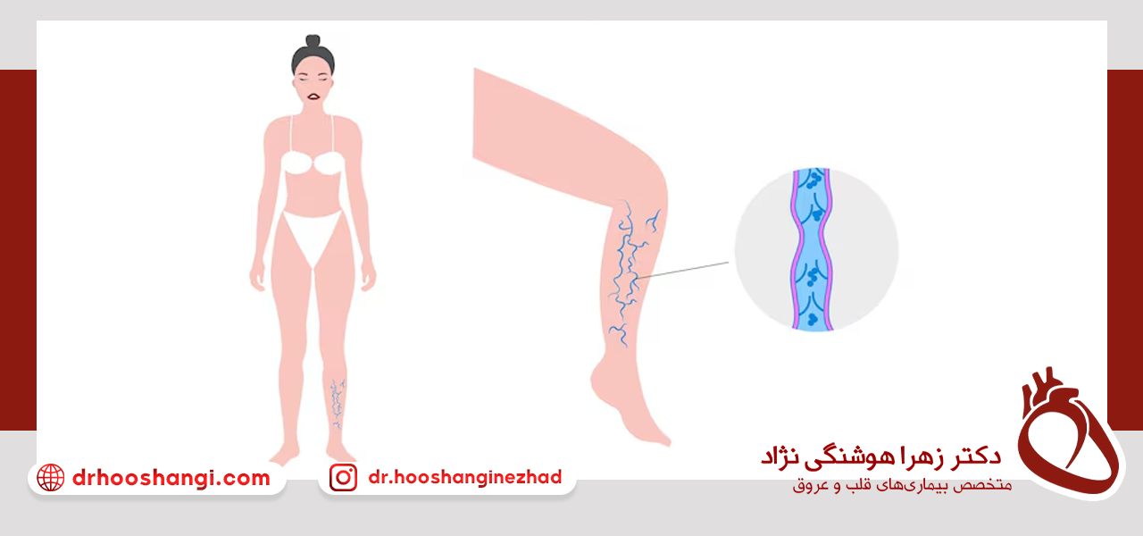 معاینه فیزیکی برای تشخیص واریس پا