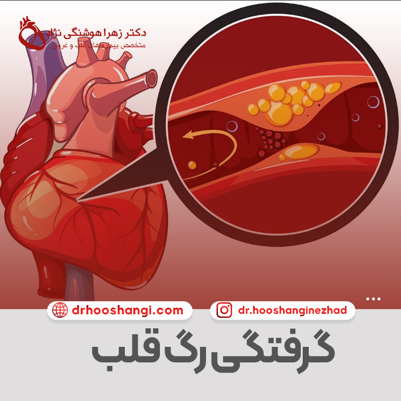 گرفتگی رگ قلب